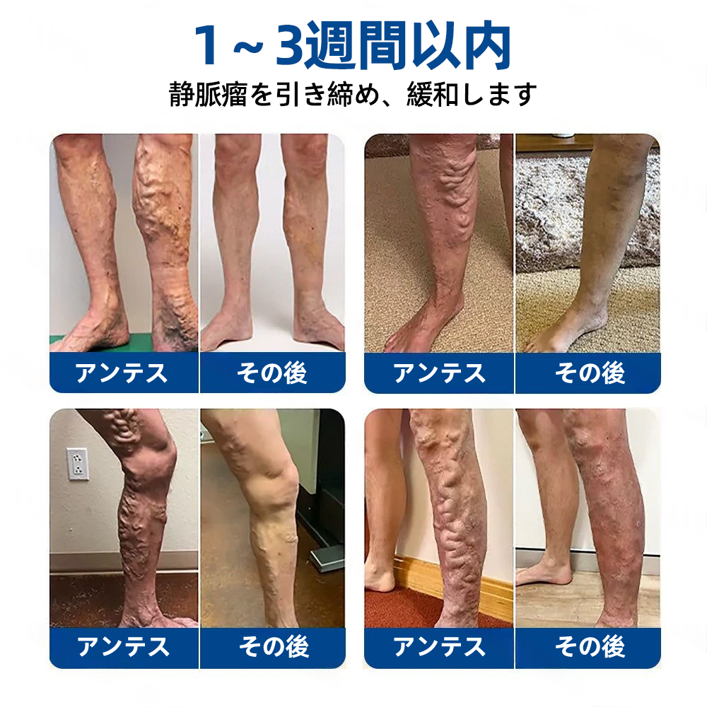 ✅𝑭𝒍𝒐𝒓𝒊𝒔𝒎𝒂®🍃🍃 𝑽𝒆𝒊𝒏𝑻𝒂𝒓𝒈𝒆𝒕 マイクロニードルパッチ⚡即時の快適感、長期的な効果