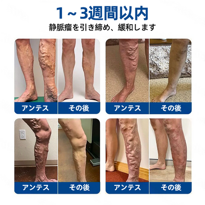 ✅𝑭𝒍𝒐𝒓𝒊𝒔𝒎𝒂®🍃🍃 𝑽𝒆𝒊𝒏𝑻𝒂𝒓𝒈𝒆𝒕 マイクロニードルパッチ⚡即時の快適感、長期的な効果
